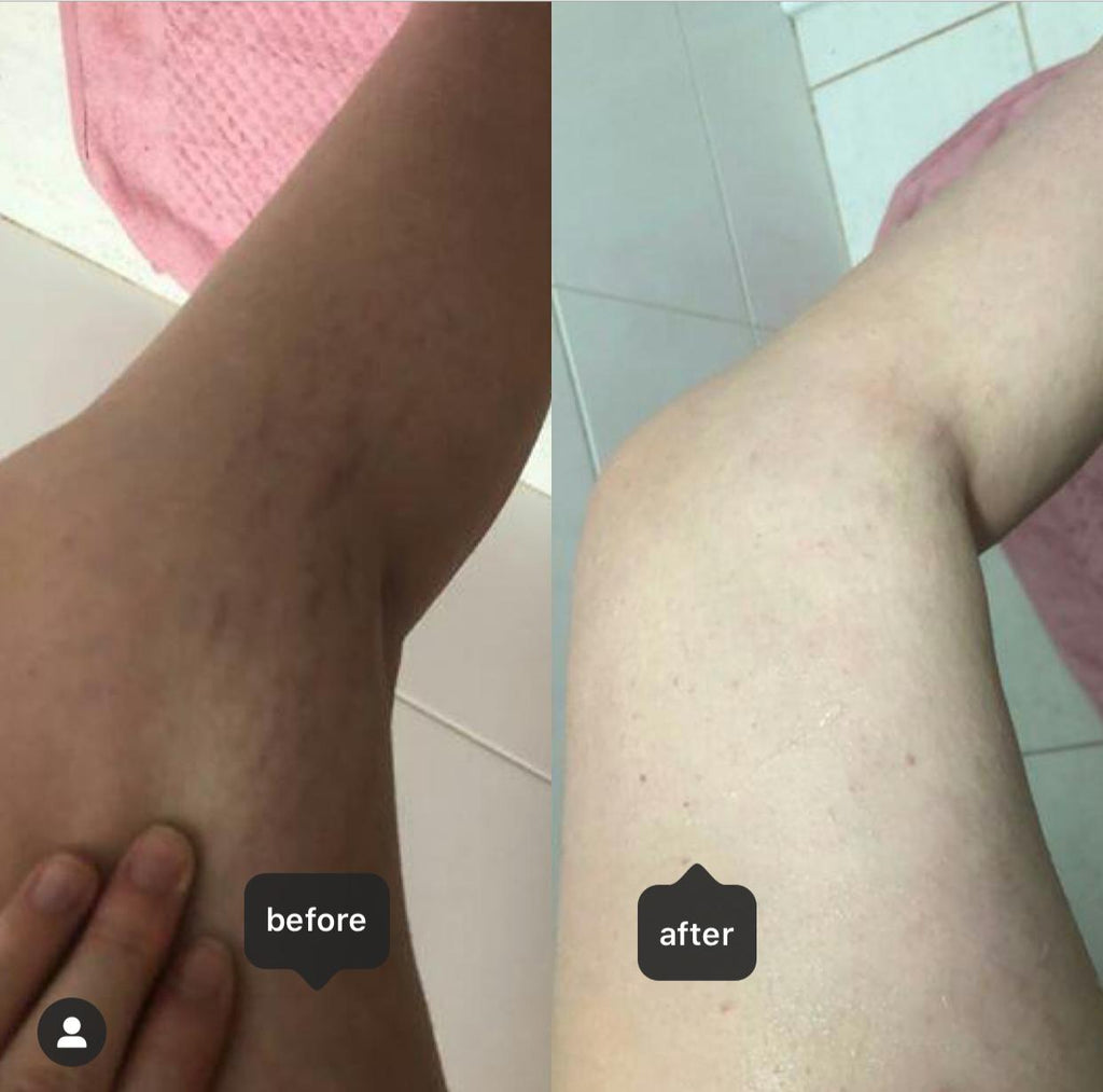 imagens do antes e depois de perna com estrias e foliculite