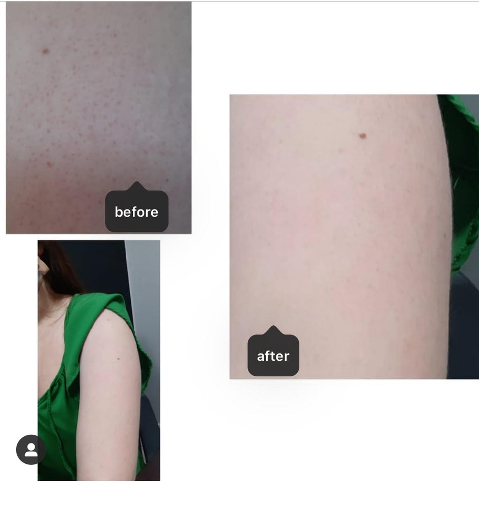 imagens do antes de depois de um braço com foliculite
